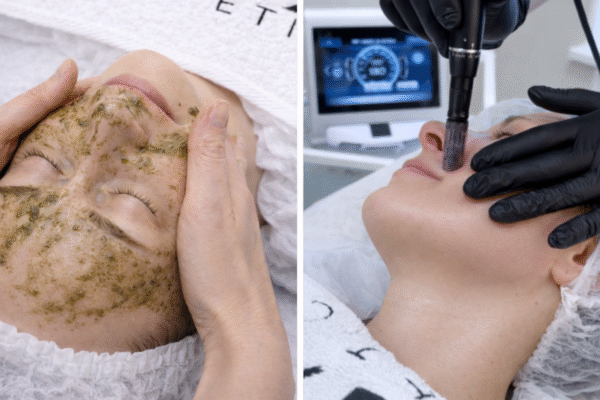 RF mikronõelumine ja näonaha koorimine (2in1 kompleks)